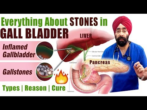 Rx GALL STONES #1 (Eng) All About Cholelithiasis | Cholecystitis | Pancreatitis | by Dr.Education Video