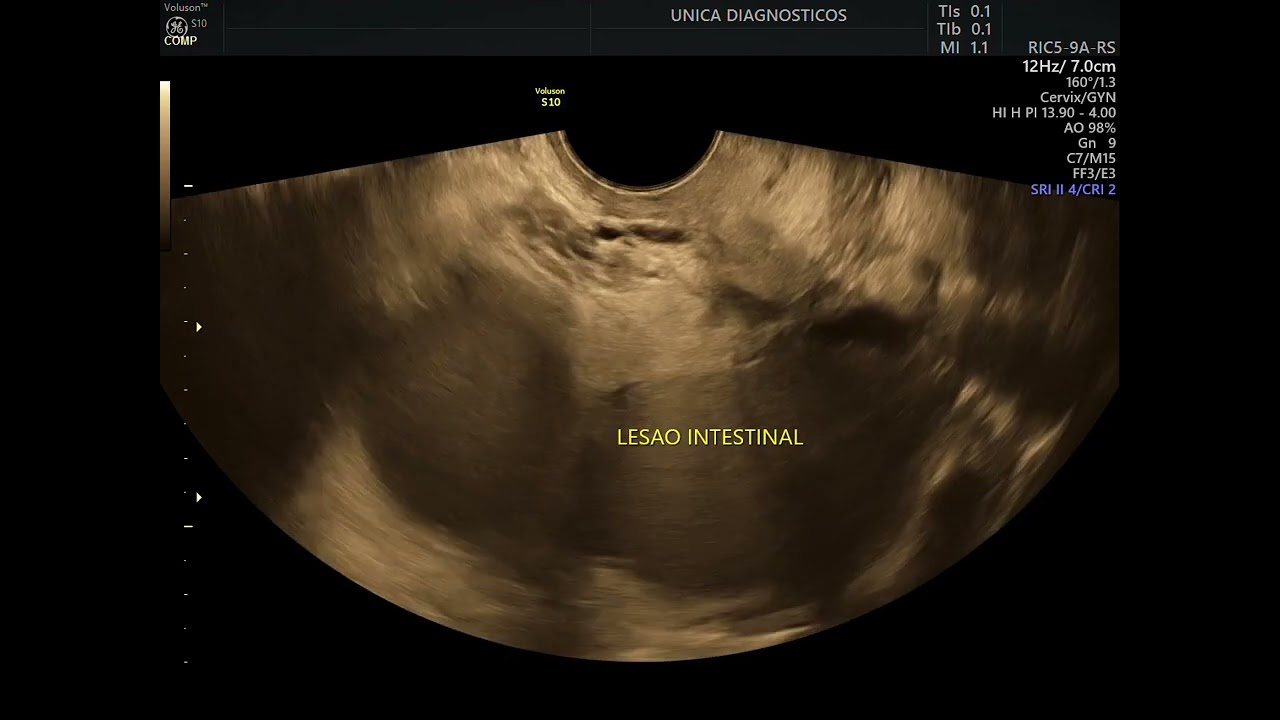 Endometrioma com completo bloqueio pélvico