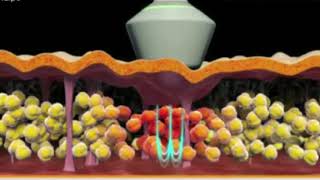 Radiofréquence Lipocavitation lipolaser 94 Créteil