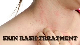Skin Rash Treatment - How to Treat Itchy Skin Rash Naturally