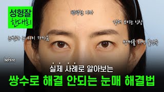 EDITION TV - 쌍수 후 얇아진 쌍꺼풀 라인, 눈 재수술 안하고 이렇게 해결 가능합니다!