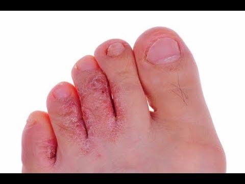 All About Athlete's Foot