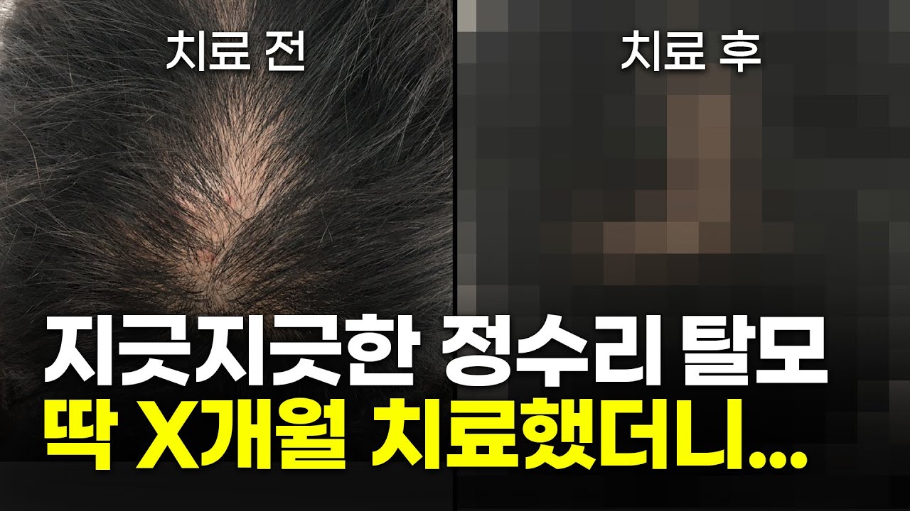 接受了X个月的毛囊注射脱发治疗...