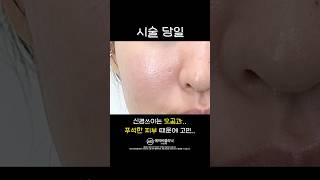 동굴 모공 포텐자로 정리하기 💕