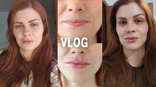 MEU PRIMEIRO PREENCHIMENTO FACIAL: LABIAL E MALAR | VLOG