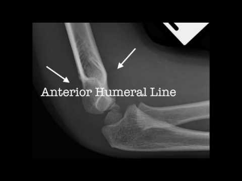 XR | Supracondylar Fractures