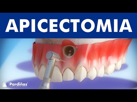 Apicectomia – Remoçao da ponta da raiz ©