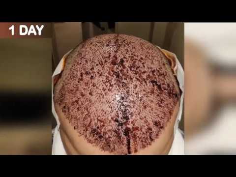 FUE Hair Transplant Timeline I Day 1 to Day 365
