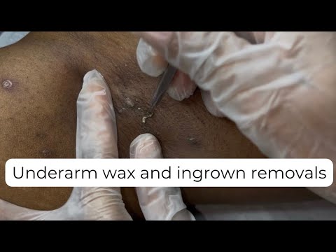 Underarm wax, ingrown hair removal and blackhead removals 