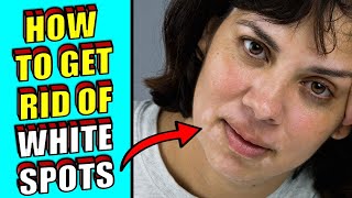 How To Get Rid of White Spots Skin & Face Naturally