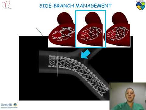 Resolute Onyx for Left Main and bifurcation stenting - Dr Francesco BURZOTTA