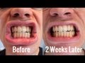 Teeth Whitening | BlanX White Shock with LED Bite ...