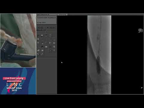 Stern D2 - Live Case - Calcified Occlusion of the R Popliteal Artery - Leipzig, Germany