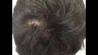 Scalp Micropigmentation Online Training Program.  SMP Online Training Program.  