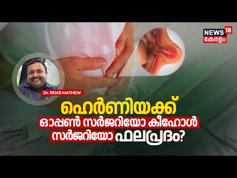 Dr. Q | ഹെർണിയക്ക് ഓപ്പൺ സർജറിയോ കീഹോൾ സർജറിയോ ഫലപ്രദം? Hernia: Symptoms, Causes & Treatment | N18V