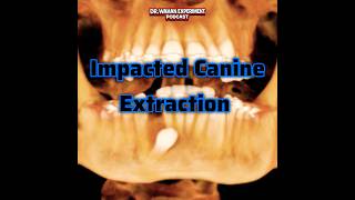Impacted Canine Extraction from Chin