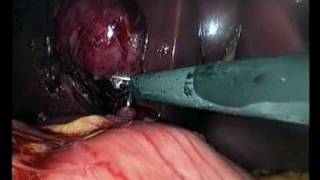preview picture of video 'cholecystectomie laparoscopique - pyocholécyste sur lithiase vesiculaire - Dr DERRADJI El Mehdi'