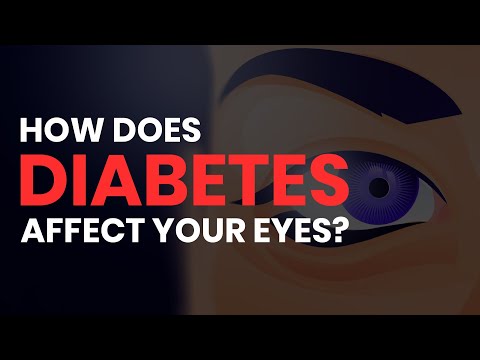 How Diabetes Affects Your Eyes (Retinopathy, Glaucoma, Cataracts, Macular Edema)