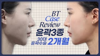 30대 윤곽 3종 수술, 케이스 리뷰 ㅣ비티성형외과