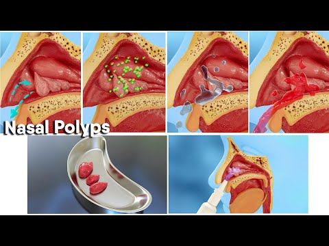 Nasal polyps treatment and surgery! 3d medical animation|Dandelion Team #nasalpolyp #noose