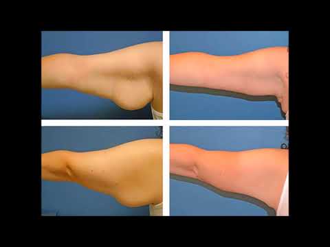 Si të hiqni dhjamin e tepërt në krahë, me anë të kësaj teknike.