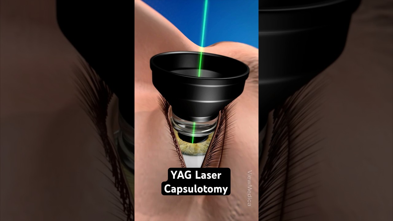 Clearing cloudy vision after cataract surgery (3D Animation)