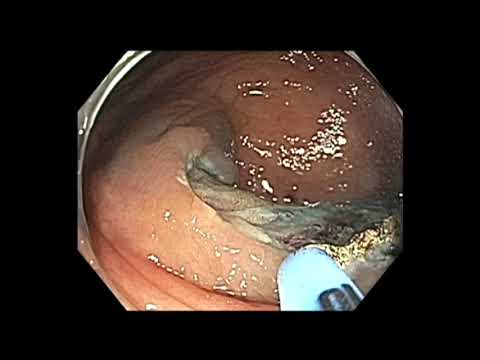 Coloscopie: mucosectomie endoscopique d'une lésion à large extension latérale (LST-G) de 3 cm du côlon ascendant