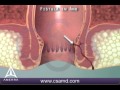 What is a fistula in ano? 3D animation