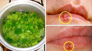 Treat A Cold Sore With This Remedy And See It Gone Overnight