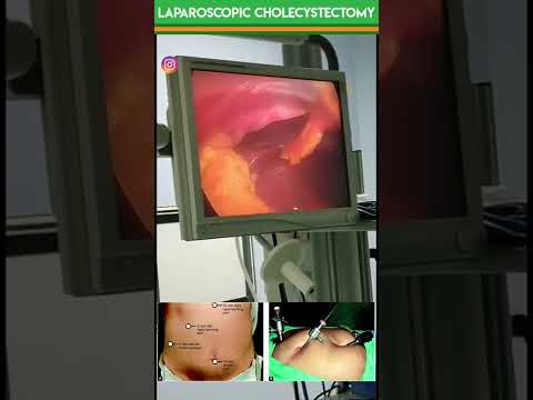 , title : 'Laparoscopic Surgery |Real Video by Medical Affairs #mbbs #nursing'