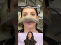 what to expect for wisdom teeth removal #shorts