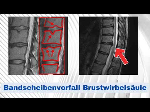 Bandscheibenvorfall Brustwirbelsäule (BWS) - Morbus Scheuermann