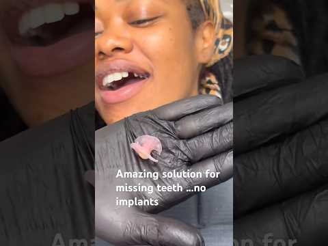 Amazing solution for missing teeth ! No implants and you can eat with it !