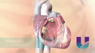 UHNN  First Lead-Less Pacemaker
