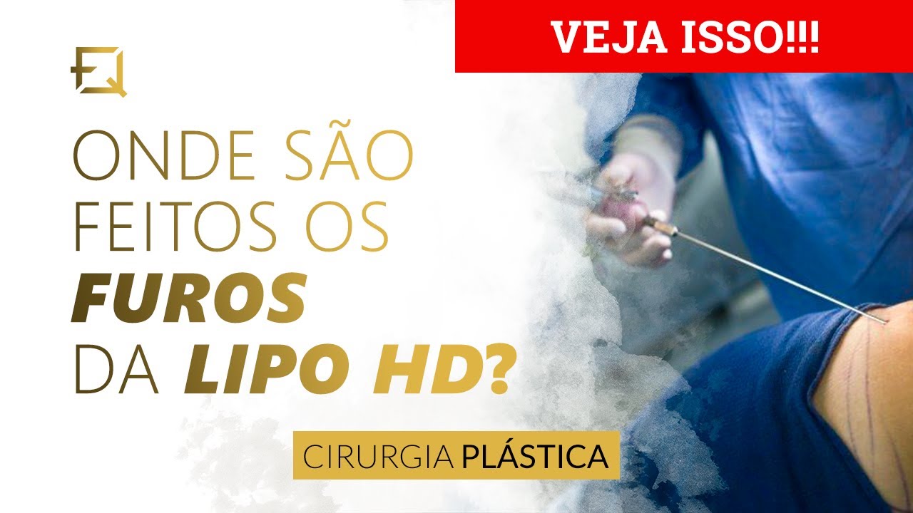 ACESSOS LIPO HD - POR ONDE COLOCAMOS A CÂNULA?