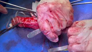 V05-01: Reduction Corporoplasty in Congenital Mega Corpora