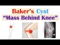 Baker Cyst (Popliteal Cyst) | Why They Occur, Symptoms, Diagnosis, Treatment