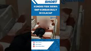 KONDISI Siswa SMP Korban Bully di Cilacap, Patah Tulang Rusuk, Postingan FB Pelaku Ramai Disorot