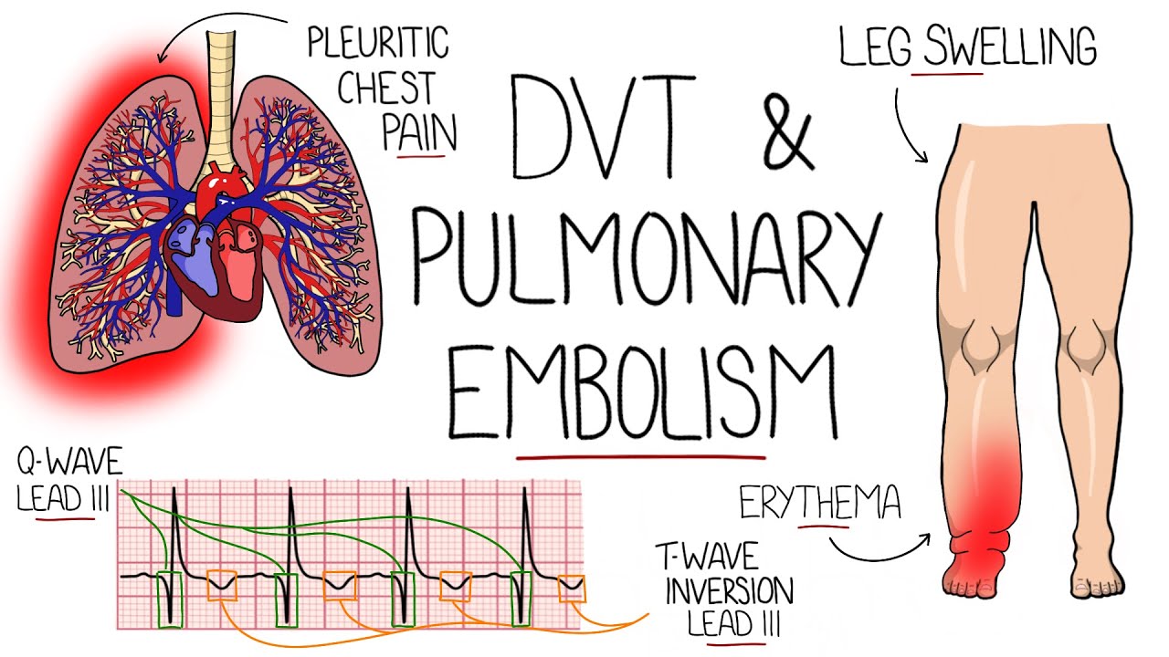 Deep Vein Thrombosis (DVT) & Pulmonary Embolism Explained