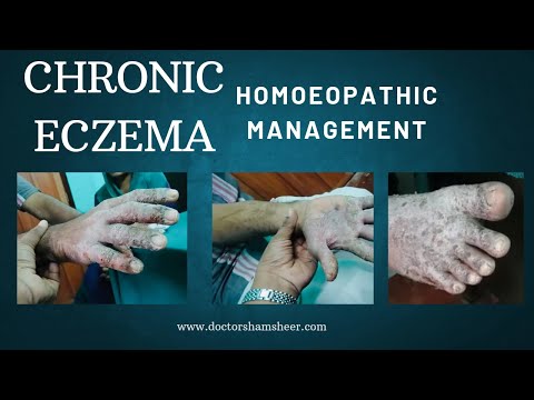 Suppressed tinea with secondary infection