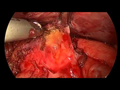 Laparoscopic Band Removal And Conversion To Sleeve Gastrectomy For Weight Regain And Dysphagia