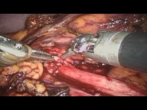 Behandlung der chronischen Prostatitis in Pyatigorsk Bienenpollen Prostata-Adenom