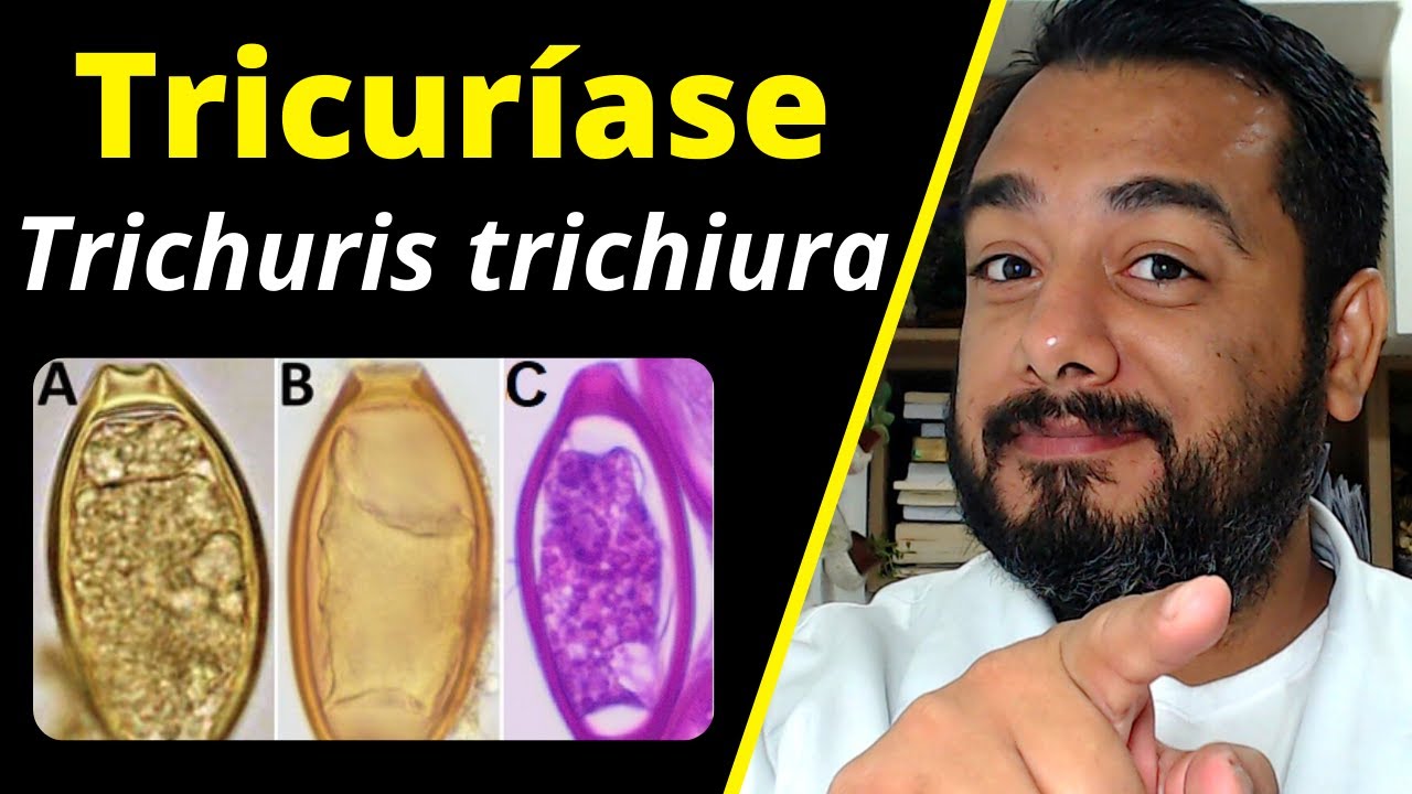 Tricuríase ou tricuriose (Trichuris trichiura): ciclo, sintomas, diagnóstico | #Parasitologia