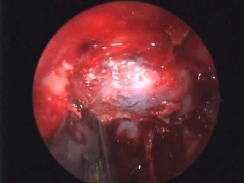 Endoscopic transphenoidal transcavernous approach