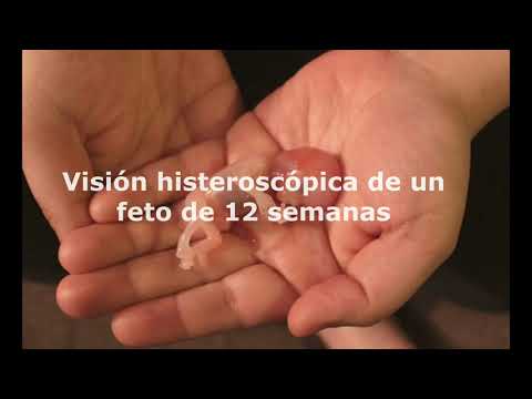 Visión histeroscópica de feto de 12 semanas