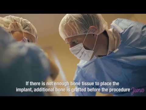 Dental Implant Procedure at Dental Art Implant Clinic