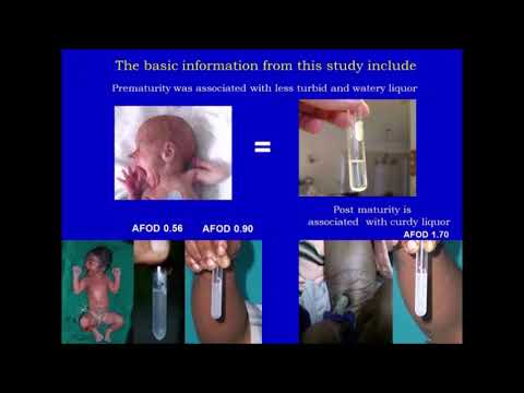 Concept Of Individual Term For Each Fetus Based On Amniotic Fluid Optical Density (AFOD) Part- I