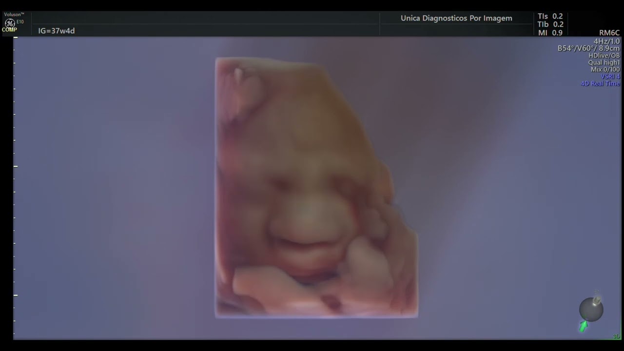 Ultrassom 4D HD Live