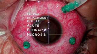 Retinal detachment due to Acute Retina Necrosis