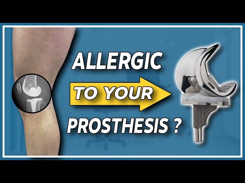 Wie kann man eine Metallallergie bei Knie- und Hüftgelenksersatz erkennen und behandeln?